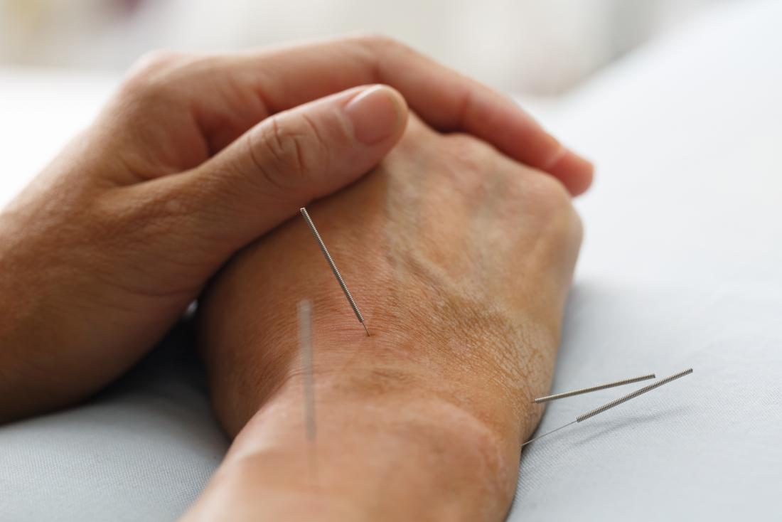 acupuncture-on-wrist
